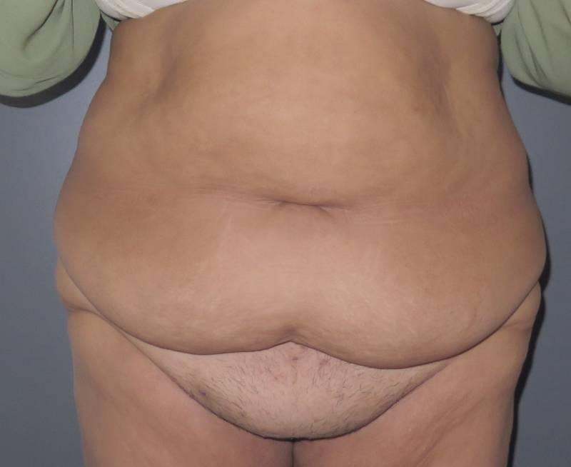 Abdominoplastie avec lifting du pubis à Marseille